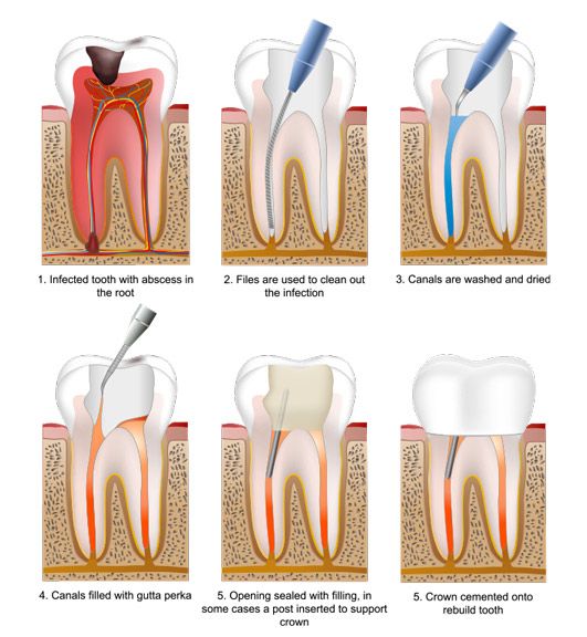 Root Canal Therapy Deering Dental in Palmetto Bay, near Pinecrest biomimetic-dentist-miami