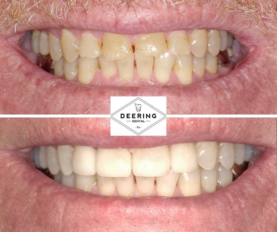 Dental Veneers Deering Dental in Palmetto Bay, near Pinecrest