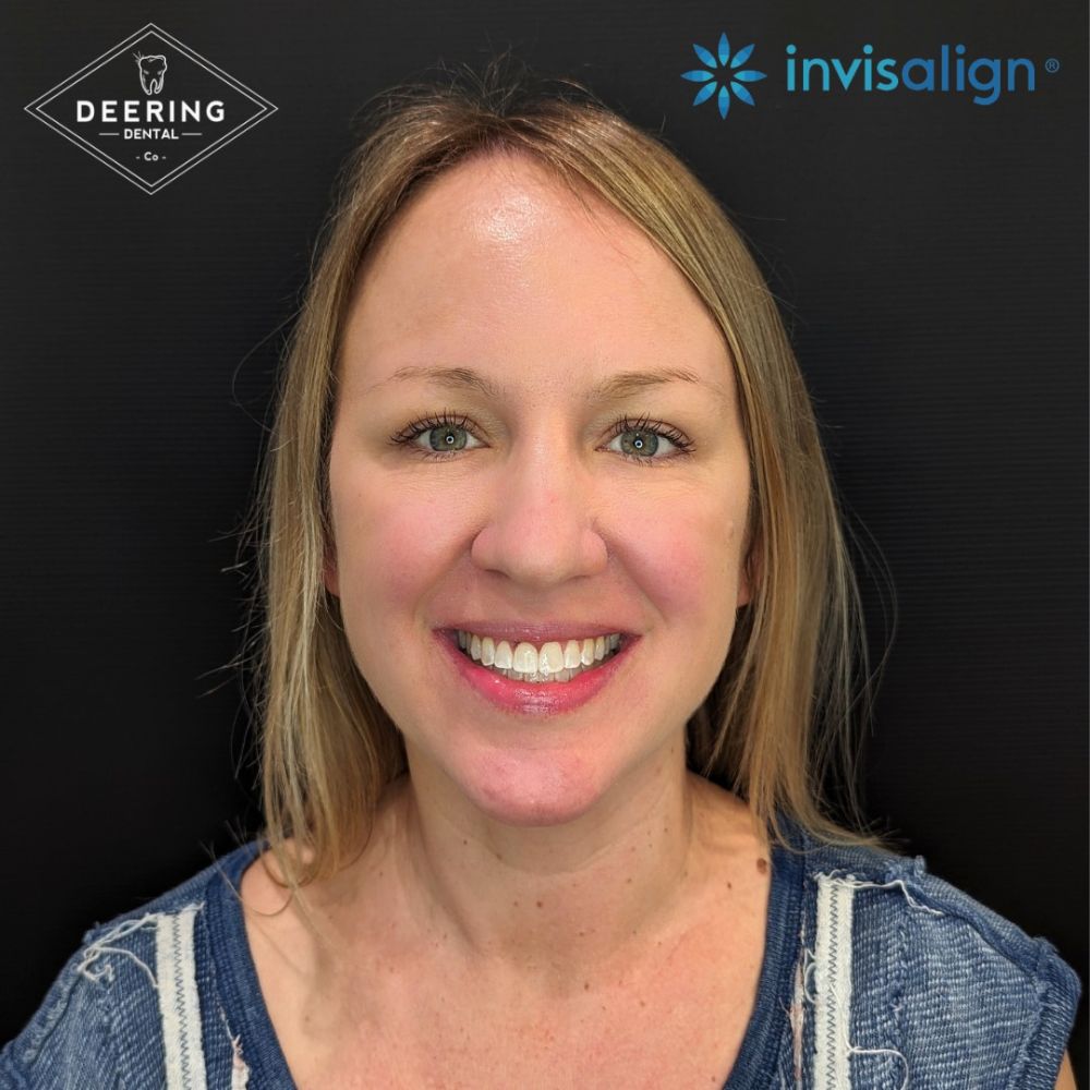 After Invisalign Treatment