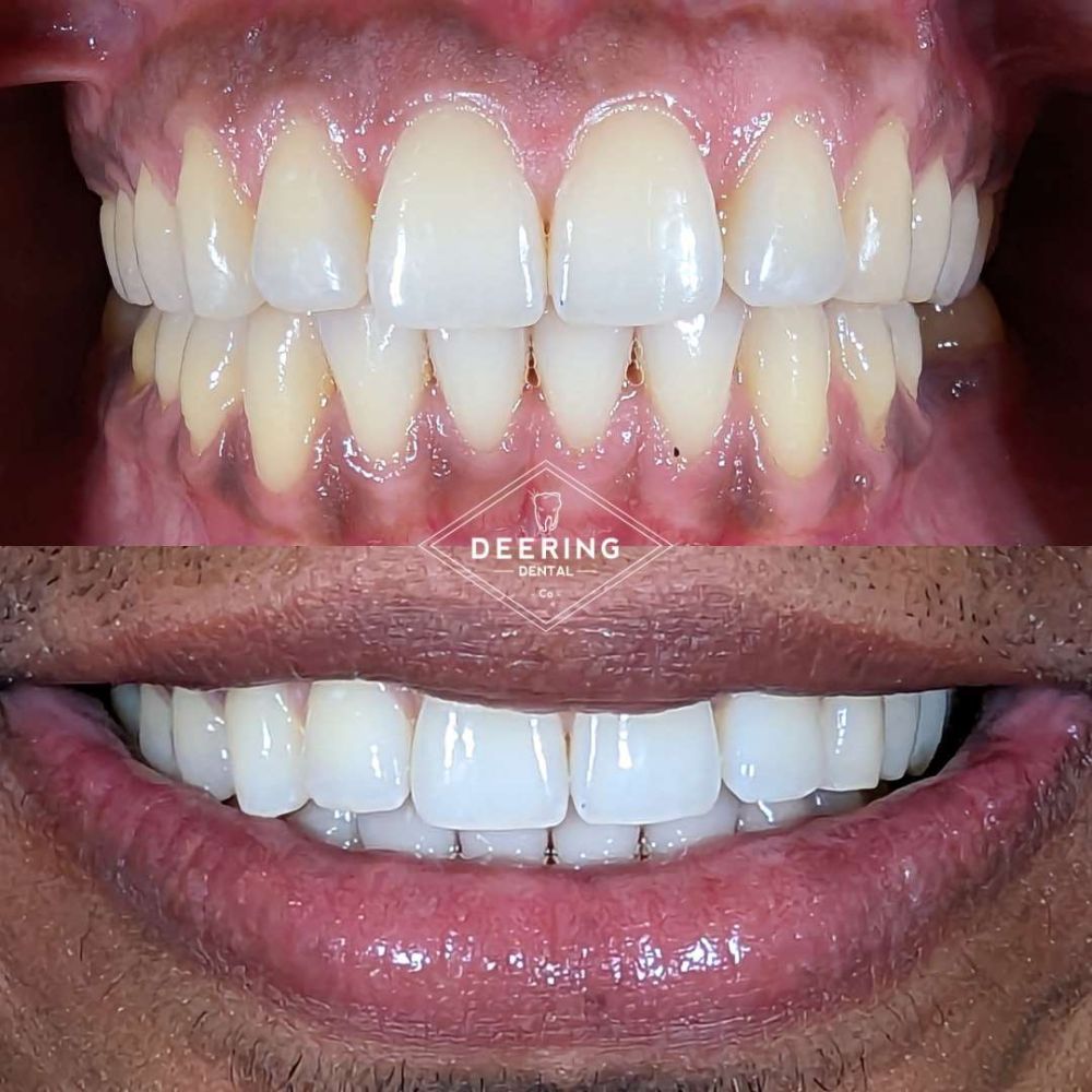 Before & After Invisalign Treatment