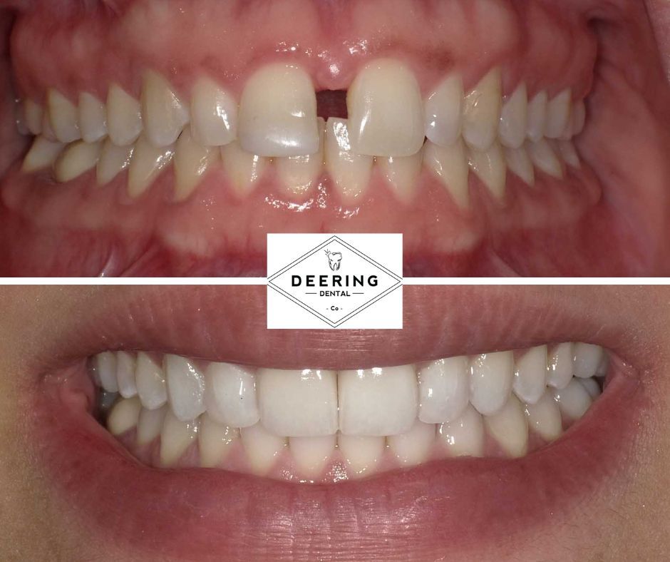 Dental Veneers Deering Dental in Palmetto Bay, near Pinecrest