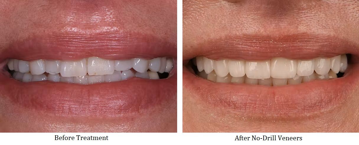 Before and after no drill veneers treatment