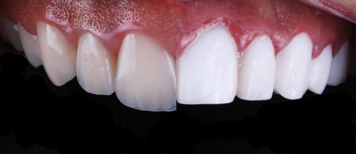 Perfect Smile 101: 8 Factors Your Cosmetic Dentist Should Never Overlook Deering Dental in Palmetto Bay, near Pinecrest