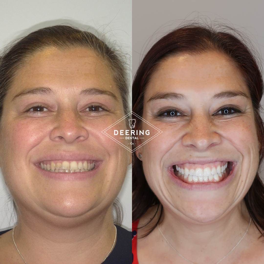 Cosmetic treatment in Miami at Deering Dental