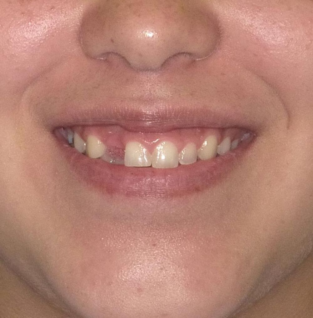 Before Dental Implant Treatment