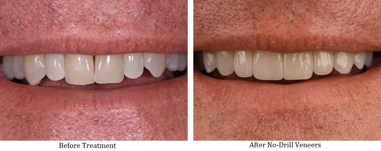 Before and after no drill veneers treatment