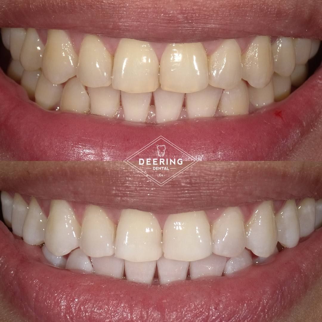 Cosmetic treatment in Miami at Deering Dental