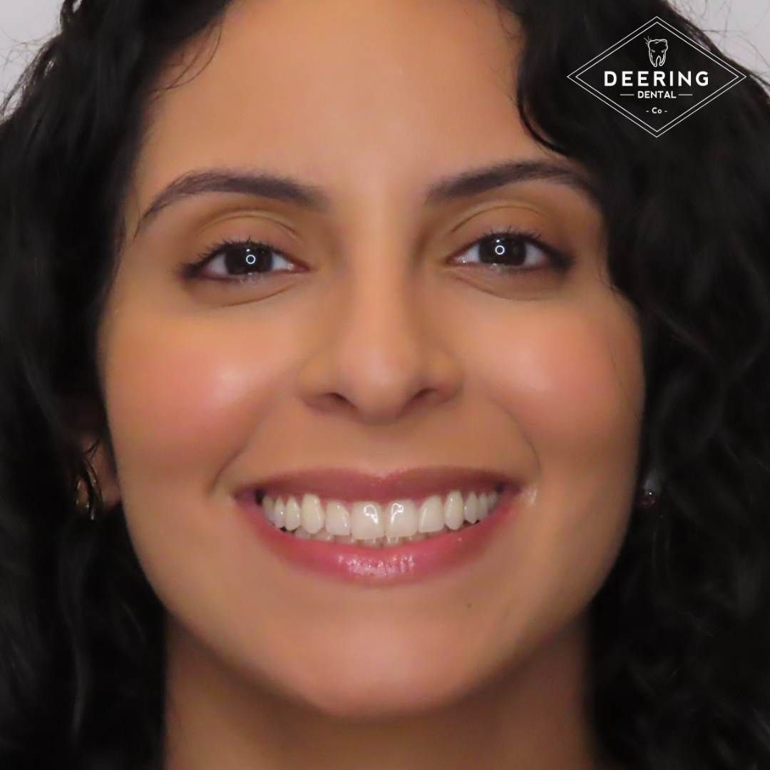 Teeth whitening results Miami