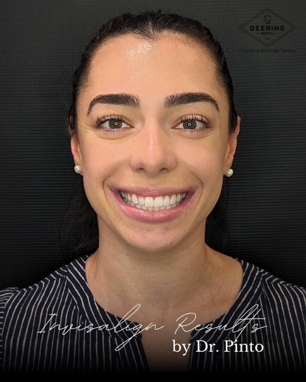 After Invisalign Treatment