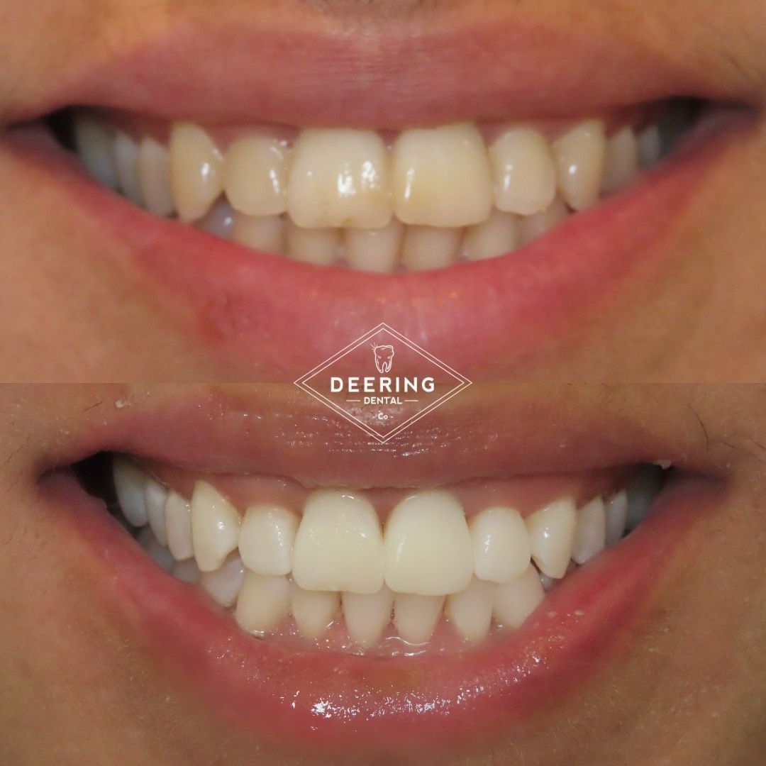 Cosmetic treatment in Miami at Deering Dental