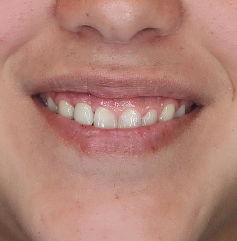 After Dental Implant Treatment