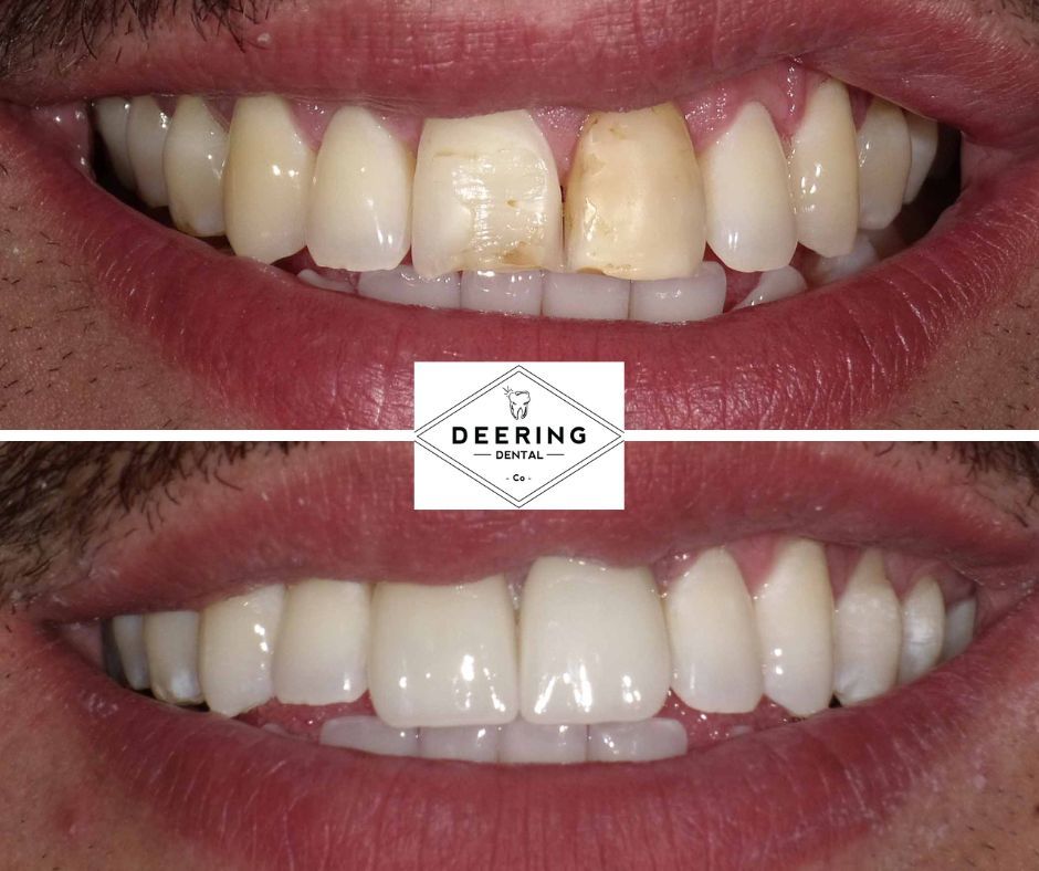 Dental Veneers Deering Dental in Palmetto Bay, near Pinecrest