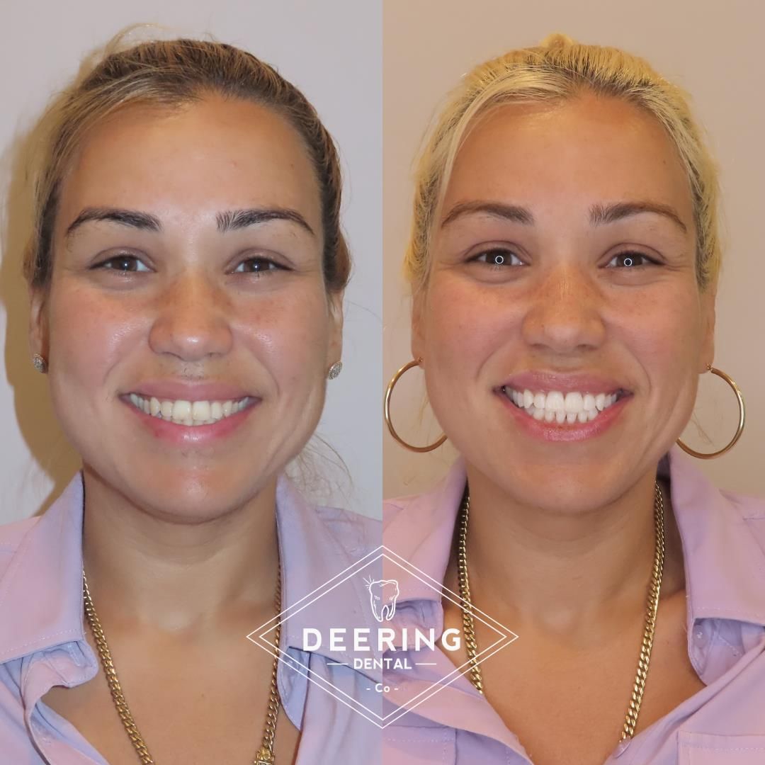 Cosmetic treatment in Miami at Deering Dental