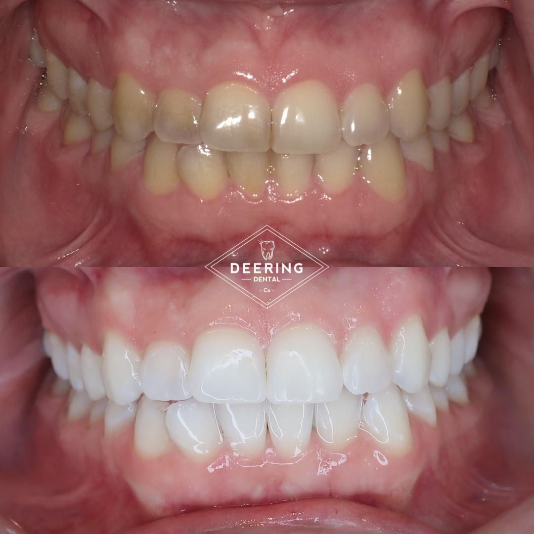 Cosmetic treatment in Miami at Deering Dental