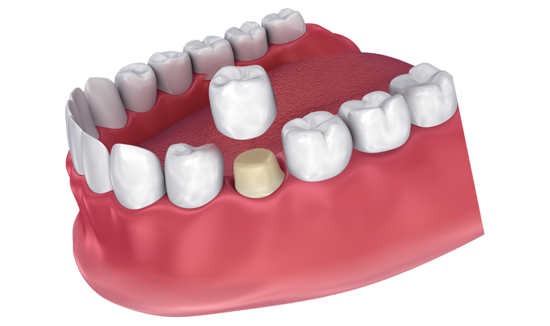 Crowns & Bridges Deering Dental in Palmetto Bay, near Pinecrest