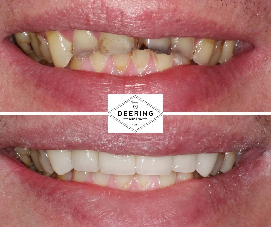 Dental Veneers Deering Dental in Palmetto Bay, near Pinecrest