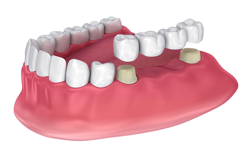Crowns & Bridges Deering Dental in Palmetto Bay, near Pinecrest