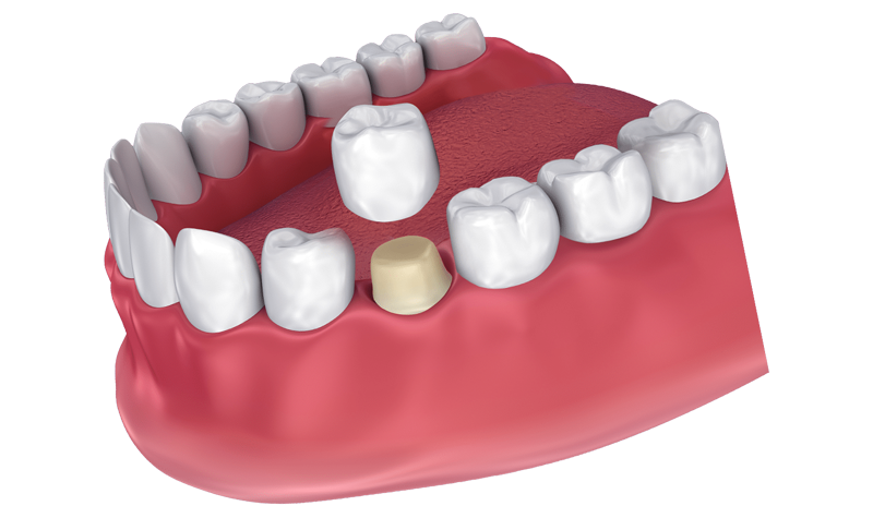 Crowns & Bridges Deering Dental in Palmetto Bay, near Pinecrest