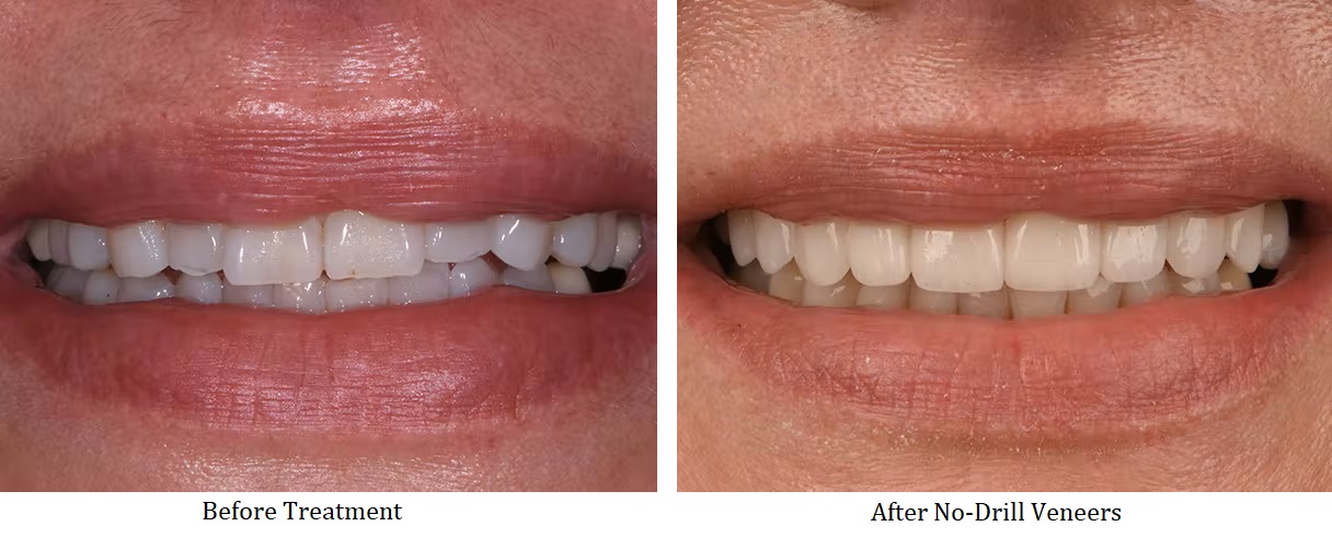 Before and after no drill veneers treatment
