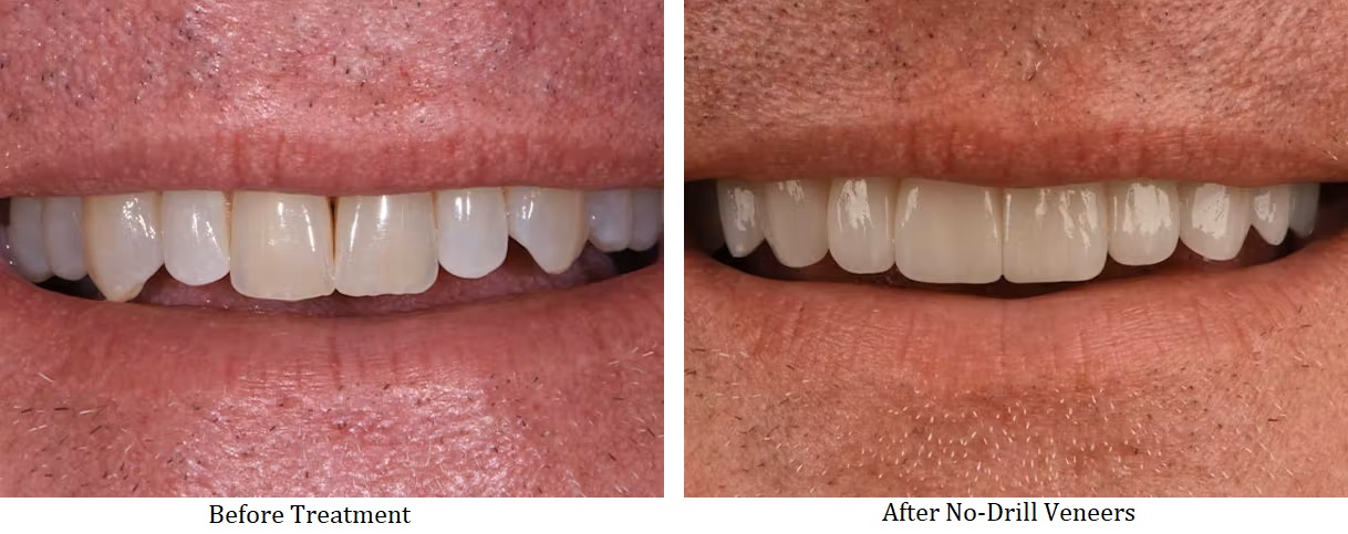 Before and after no drill veneers treatment