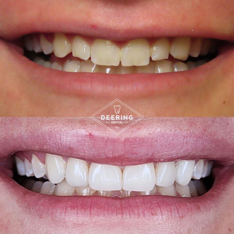 before and afters of the veneers treatment