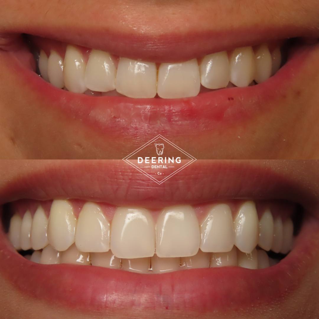 Teeth whitening results Miami