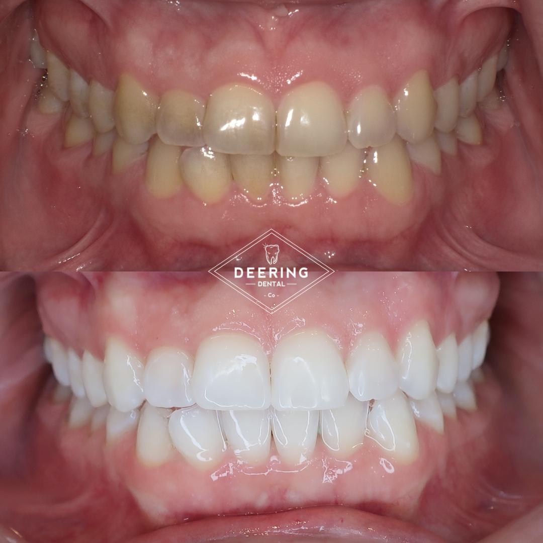 Best Cosmetic Dentist Miami Deering Dental in Palmetto Bay, near Pinecrest