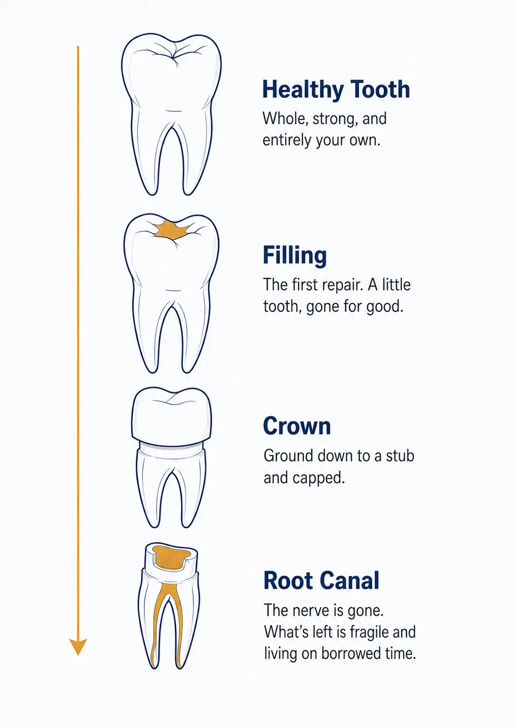 Illustration of the standard dental cycle: the same tooth shown in four stages, healthy, then with a filling, then ground down for a crown, then hollowed by a root canal, with each stage leaving less natural tooth than the one before.