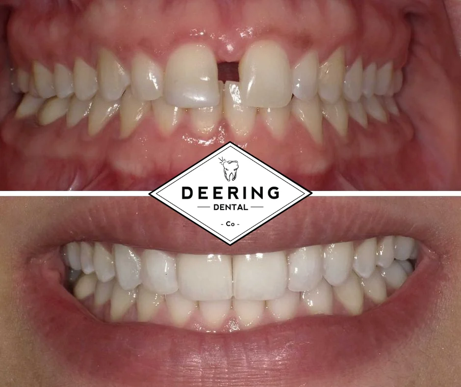 Invisalign Dentist Palmetto Bay Deering Dental in Palmetto Bay, near Pinecrest Before and after Invisalign at Deering Dental: a gap between the front teeth, closed