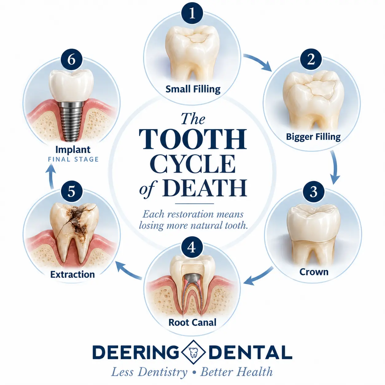 The Tooth Cycle of Death: small filling, bigger filling, crown, root canal, extraction, implant