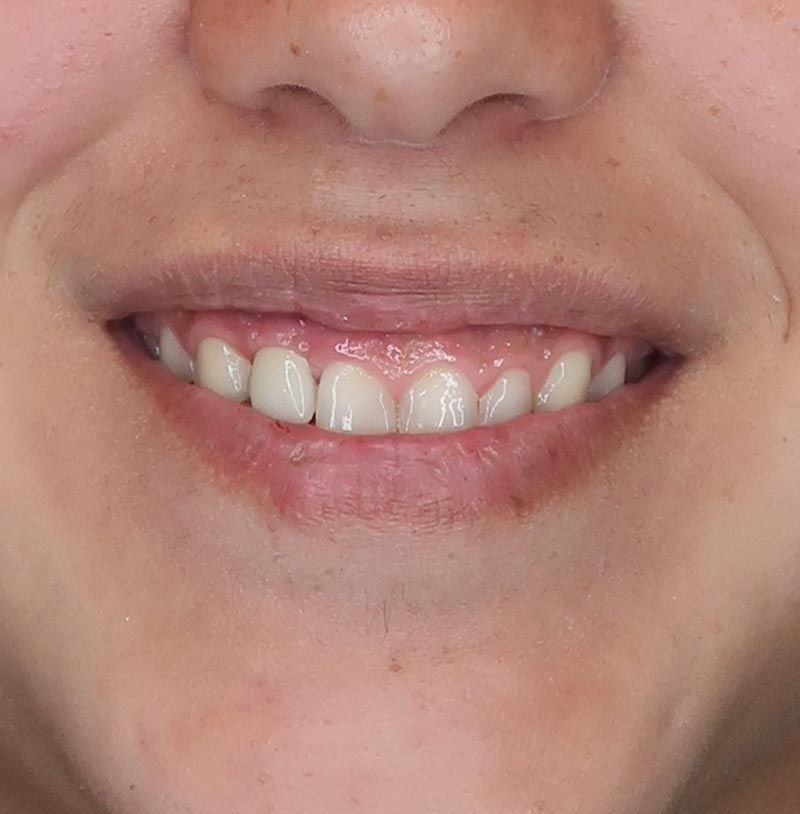 Recover Smile With Deering Dental Implants Deering Dental in Palmetto Bay, near Pinecrest After Dental Implant Treatment