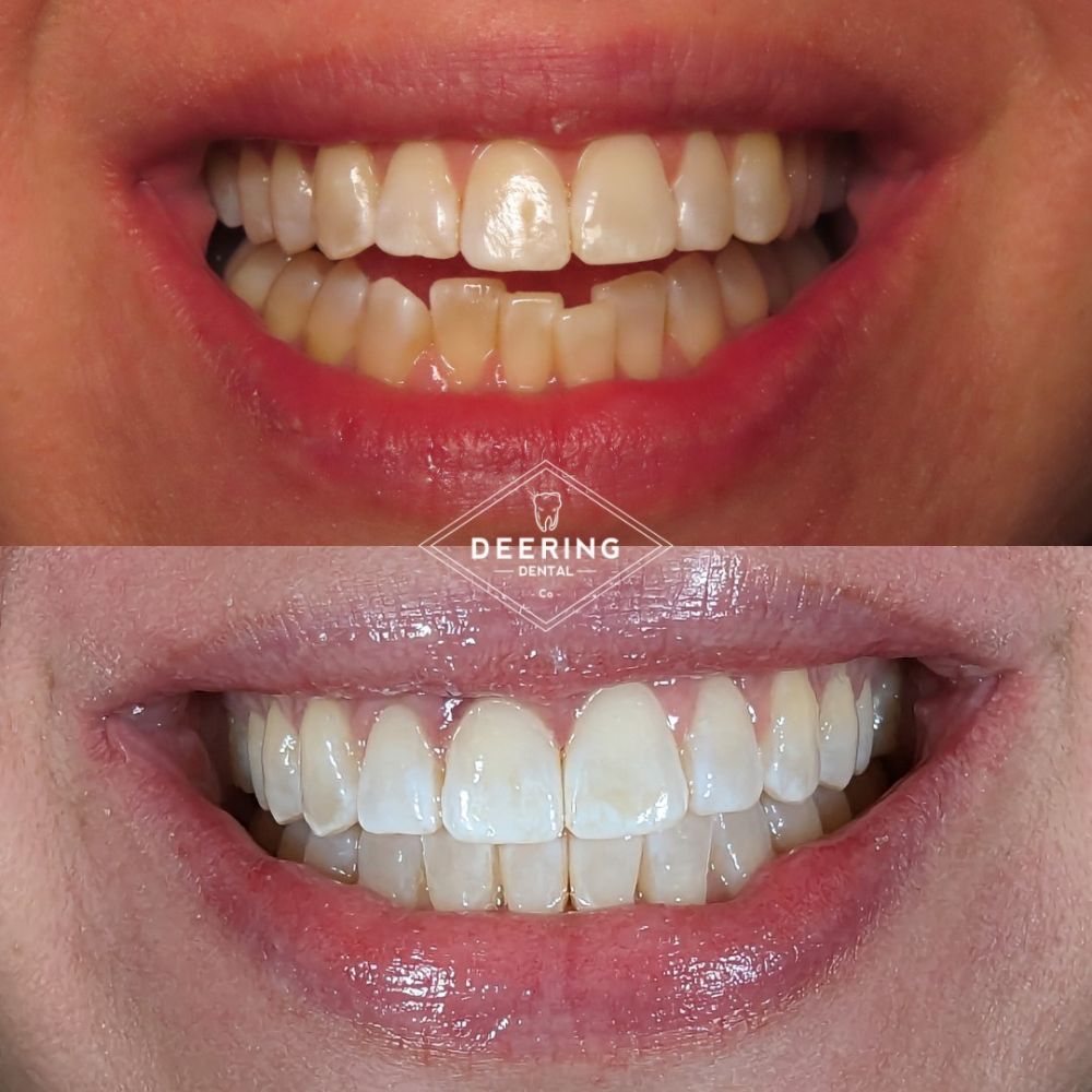 Invisalign Dentist Palmetto Bay Deering Dental in Palmetto Bay, near Pinecrest Before & After Invisalign Treatment